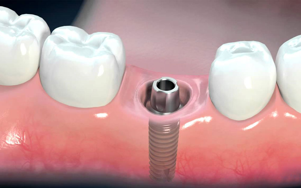 formation assistante dentaire implantologie
